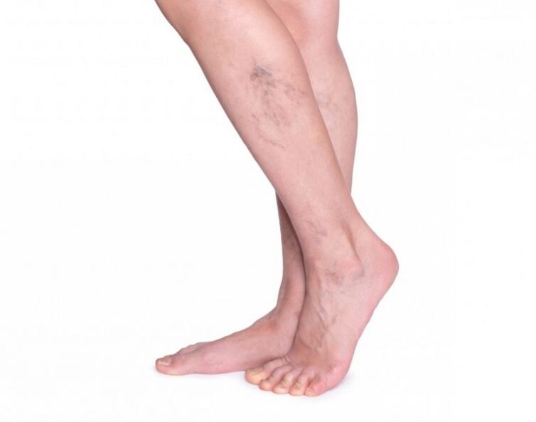 Varicose veins before varicon of treatment