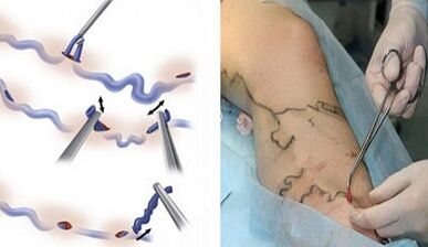 Phlebectomy for varicose veins in the foot