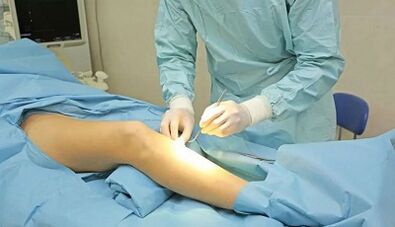 How a varicose veins operation is performed