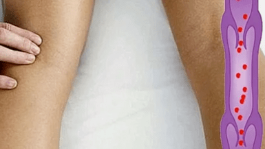 Reasons for developing varicose veins of lower extremities