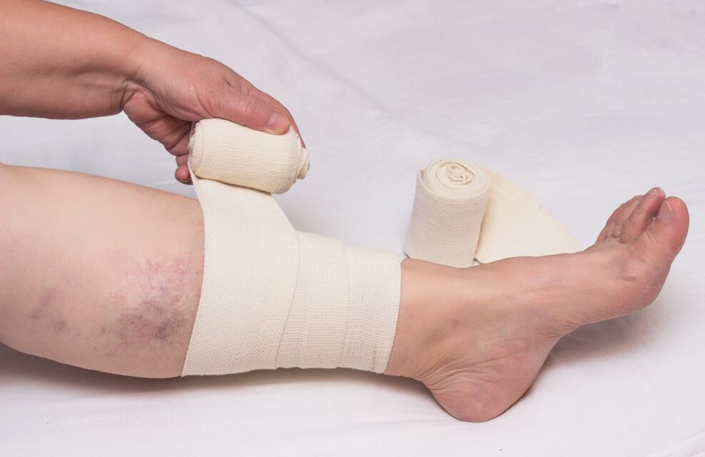 Treatment of Varicose vein compression