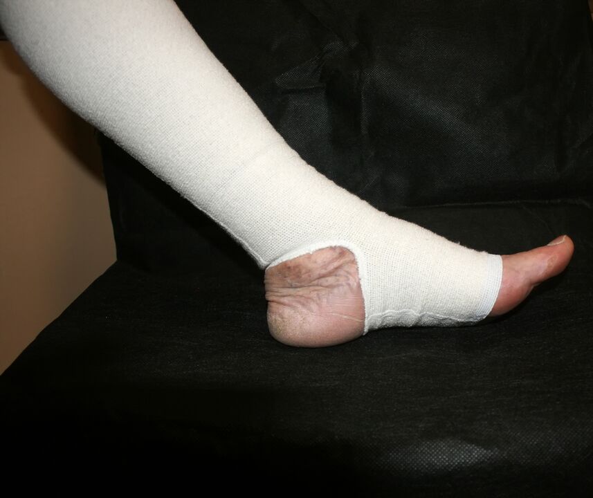 Tricotage coating for compression for varicose veins
